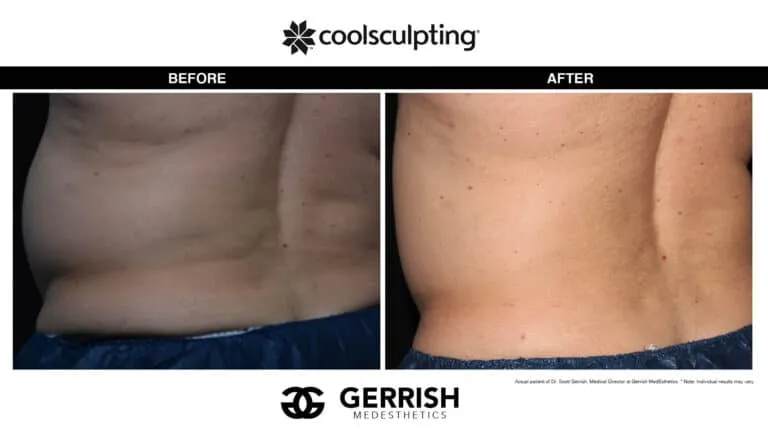 Before & After Gallery - CoolSculpting  Gerrish MedEsthetics Real Patient  Results